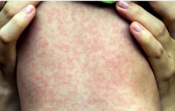 Michoacán reporta cuarto caso de sarampión en Maravatío